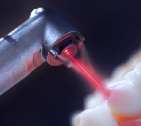 occlusodonthie laser toulouse dentiste